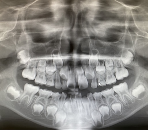 ７歳。昨年の11月に矯正専門病院で上顎正中に逆向きの埋伏過剰歯が発見されました。