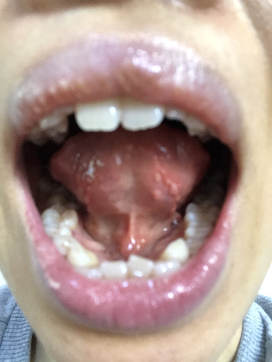 3日前から舌の先端に少し違和感ありました。