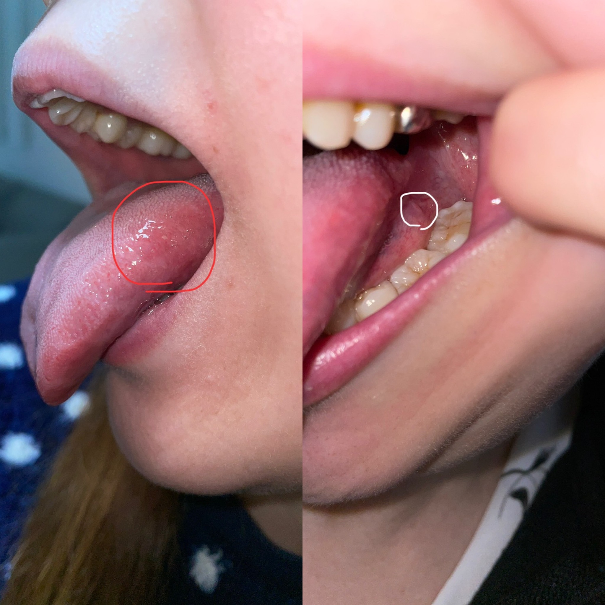 口腔癌 舌癌 かもとこわいです 口腔外科 Com 提供は安原歯科医院