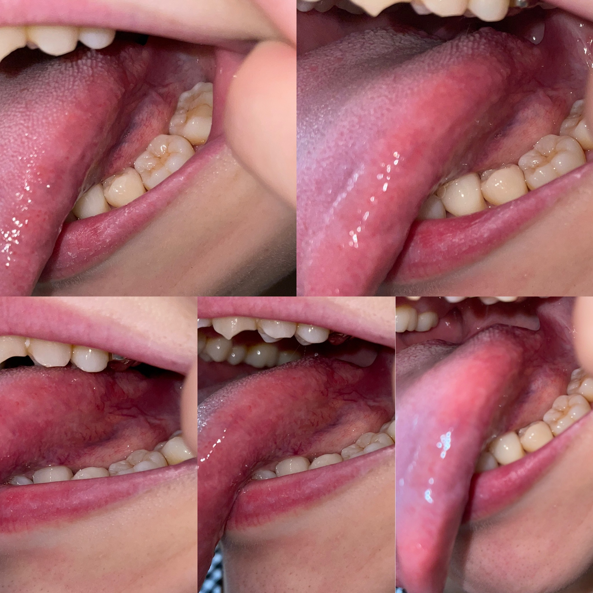 舌癌の可能性はありませんか 口腔外科 Com 提供は安原歯科医院