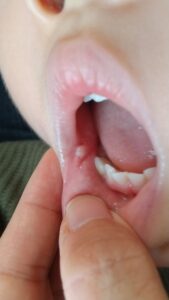 歯茎 白い 赤ちゃん 赤ちゃんの歯茎が白い！白い点があるのは病気なの？病院に行く目安は？