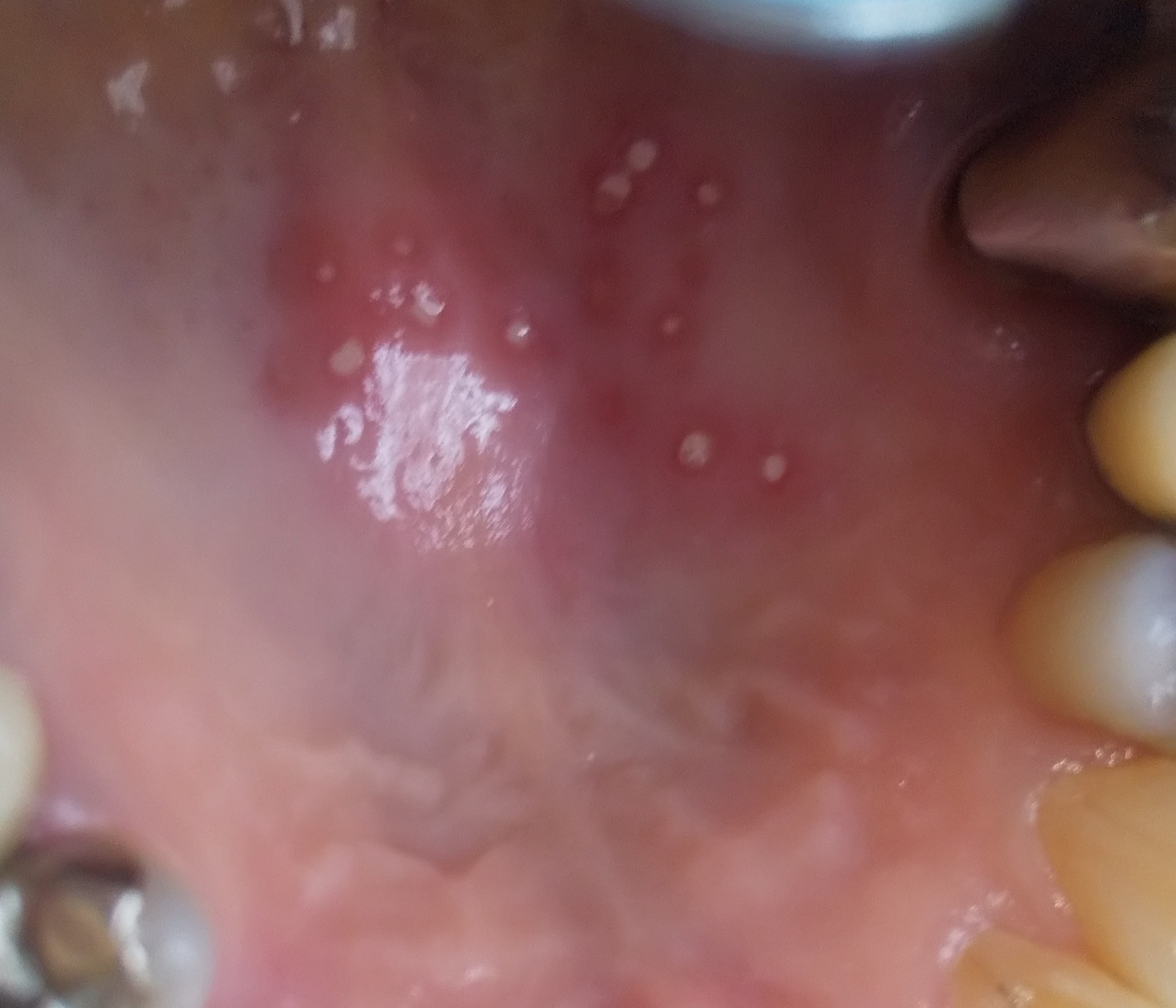 白いぽつぽつが数個あります 口内炎でなくヘルペスでしょうか 口腔外科 Com 提供は安原歯科医院