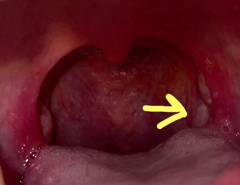 扁桃腺の後ろの壁の部分が、両サイド白っぽく見えます。特に右の方が白くみえます、、 | 口腔外科.com-提供は安原歯科医院